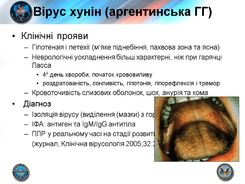 Вірус хунін (аргентинська ГГ) Клінічні прояви Гіпотензія і петехії (м’яке піднебіння, пахвова зона та